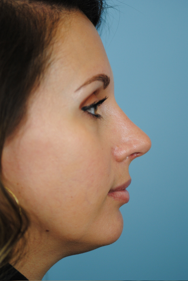 Rhinoplasty Before and After | Thomas Funcik MD