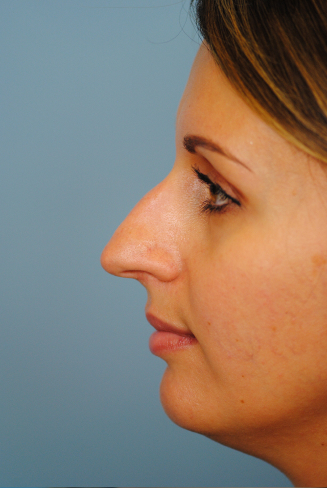 Rhinoplasty Before and After | Thomas Funcik MD