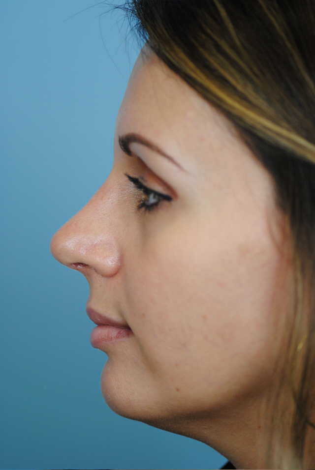 Rhinoplasty Before and After | Thomas Funcik MD