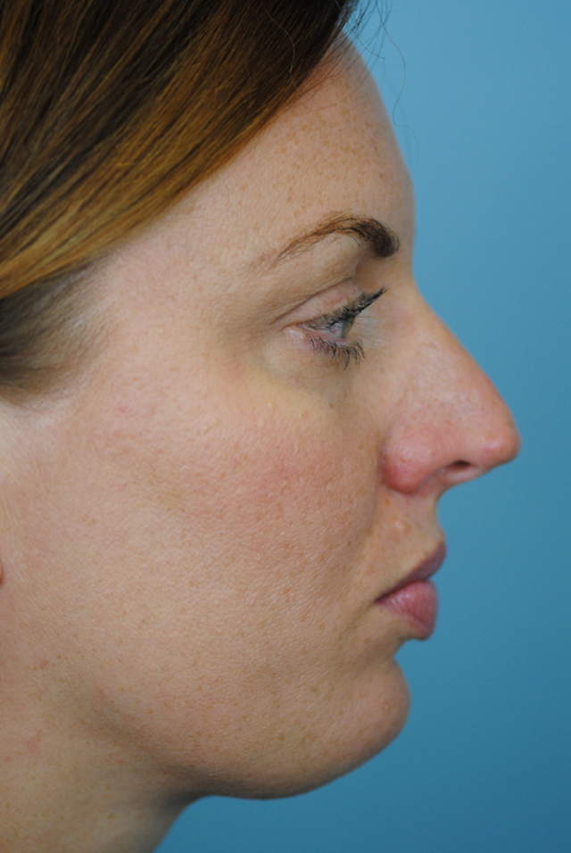 Rhinoplasty Before and After | Thomas Funcik MD