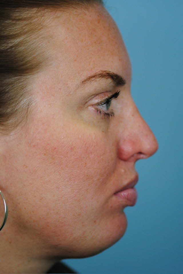 Rhinoplasty Before and After | Thomas Funcik MD