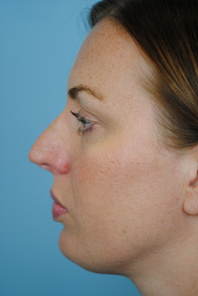 Rhinoplasty Before and After | Thomas Funcik MD