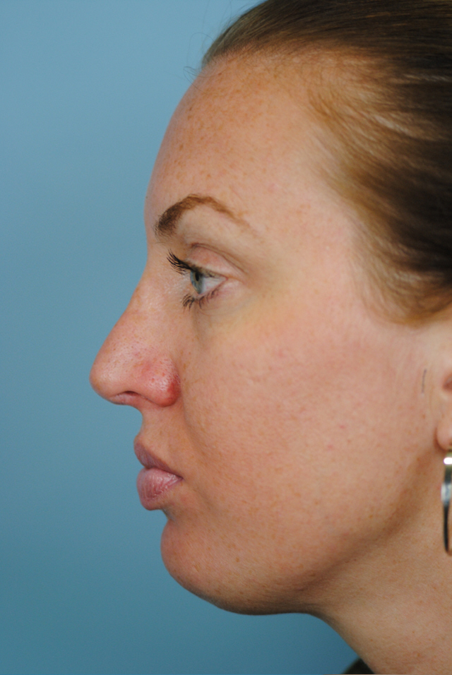 Rhinoplasty Before and After | Thomas Funcik MD