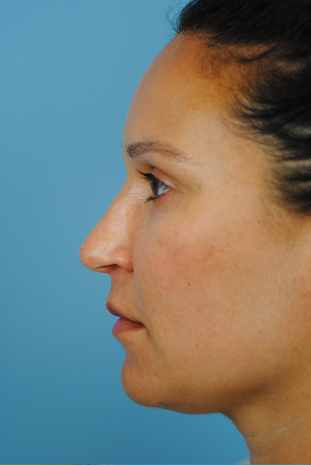 Rhinoplasty Before and After | Thomas Funcik MD