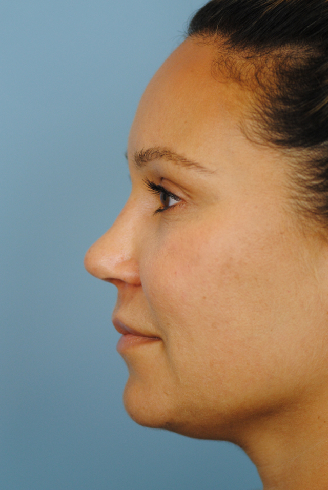 Rhinoplasty Before and After | Thomas Funcik MD