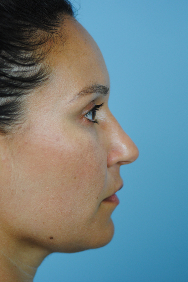 Rhinoplasty Before and After | Thomas Funcik MD