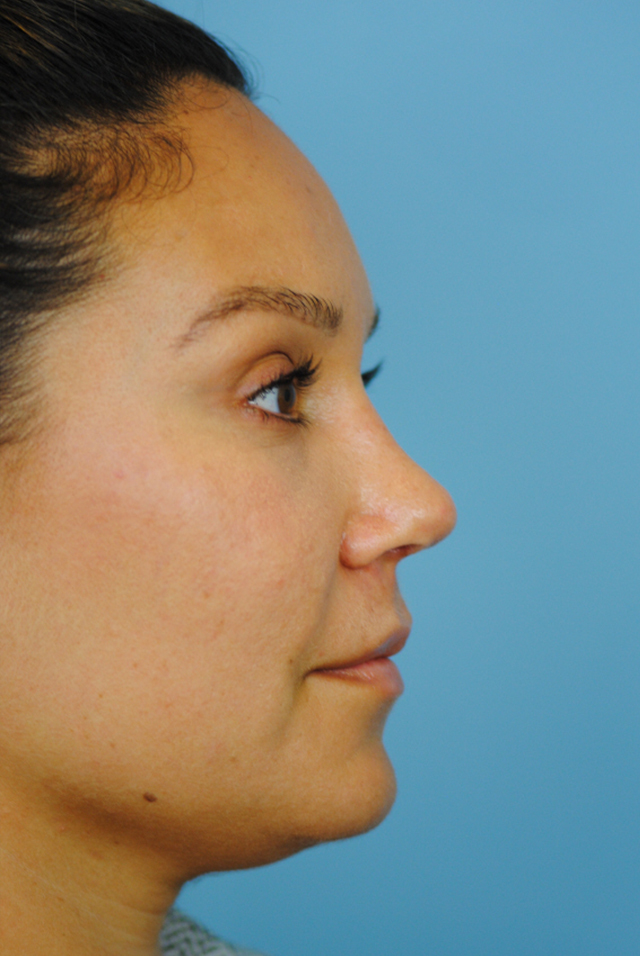 Rhinoplasty Before and After | Thomas Funcik MD