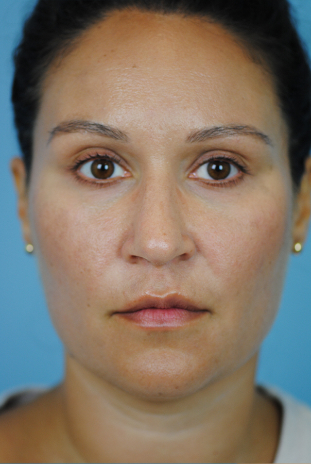 Rhinoplasty Before and After | Thomas Funcik MD