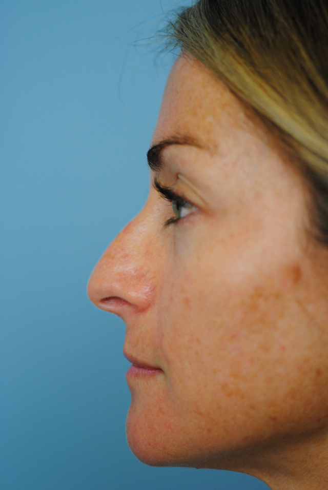 Rhinoplasty Before and After | Thomas Funcik MD