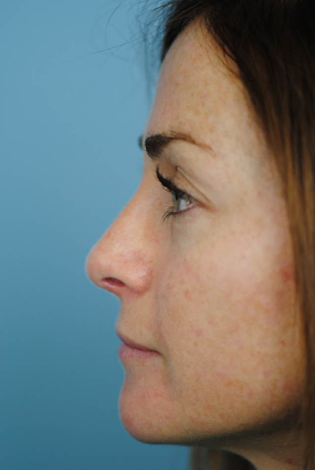 Rhinoplasty Before and After | Thomas Funcik MD