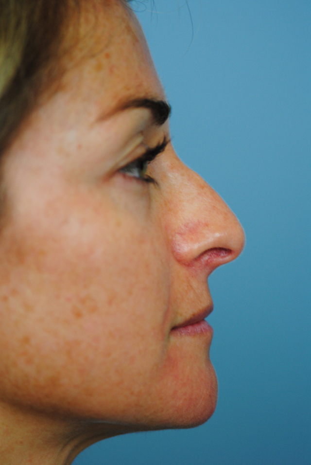 Rhinoplasty Before and After | Thomas Funcik MD