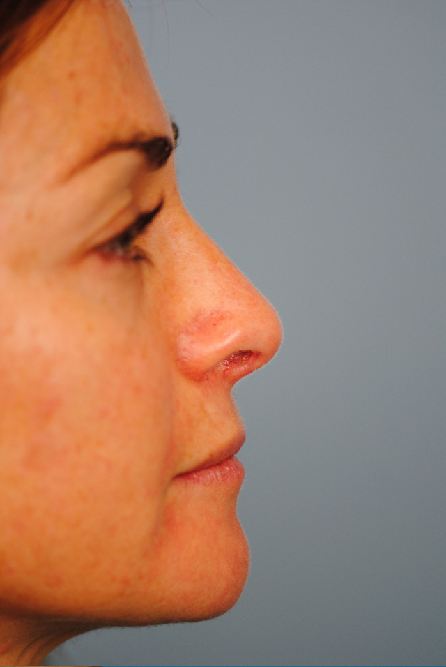 Rhinoplasty Before and After | Thomas Funcik MD