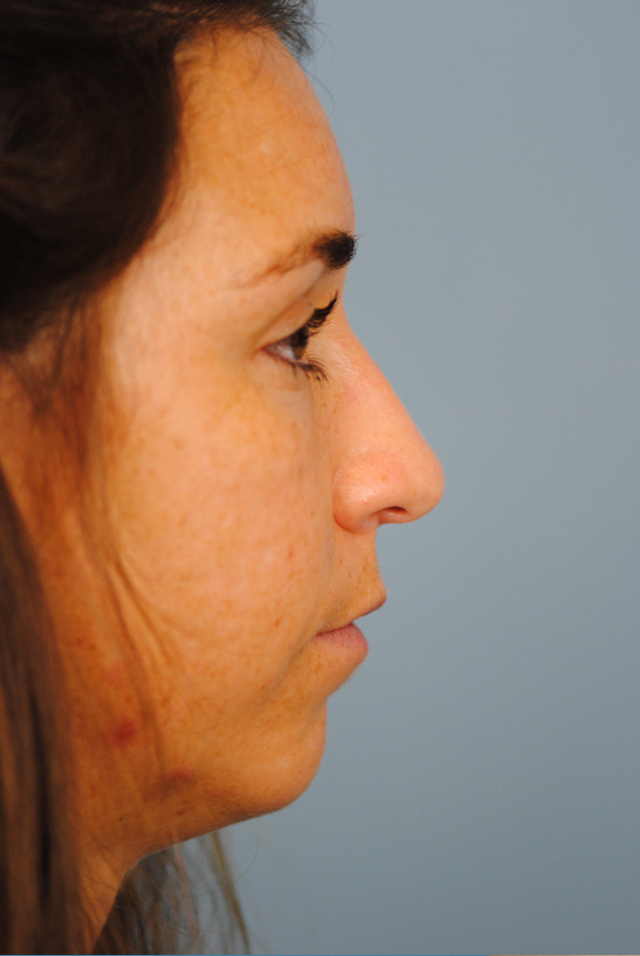 Rhinoplasty Before and After | Thomas Funcik MD