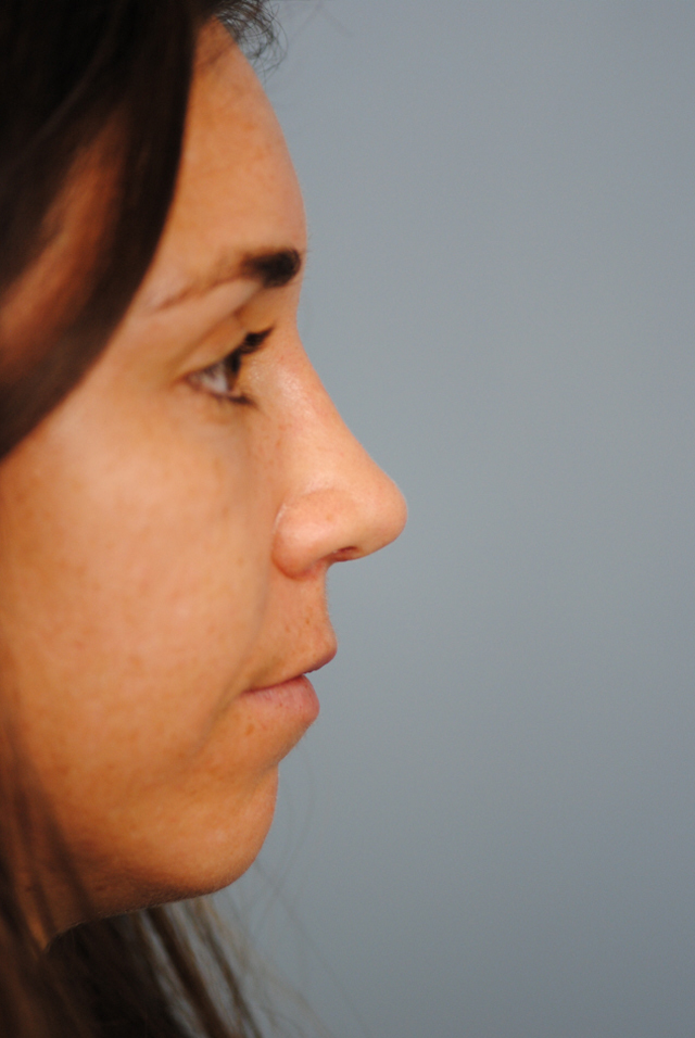 Rhinoplasty Before and After | Thomas Funcik MD