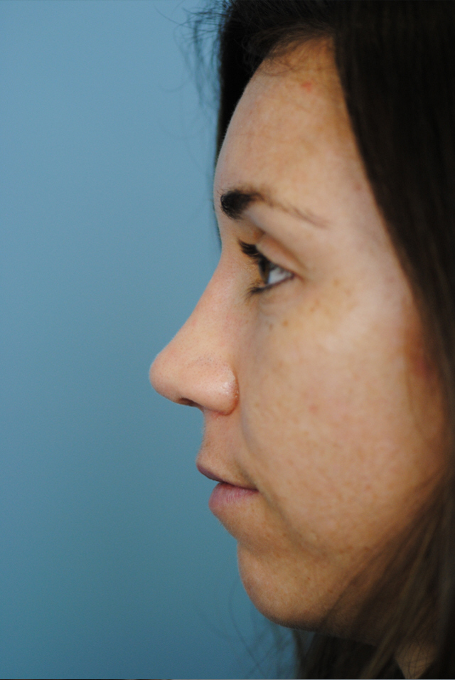 Rhinoplasty Before and After | Thomas Funcik MD