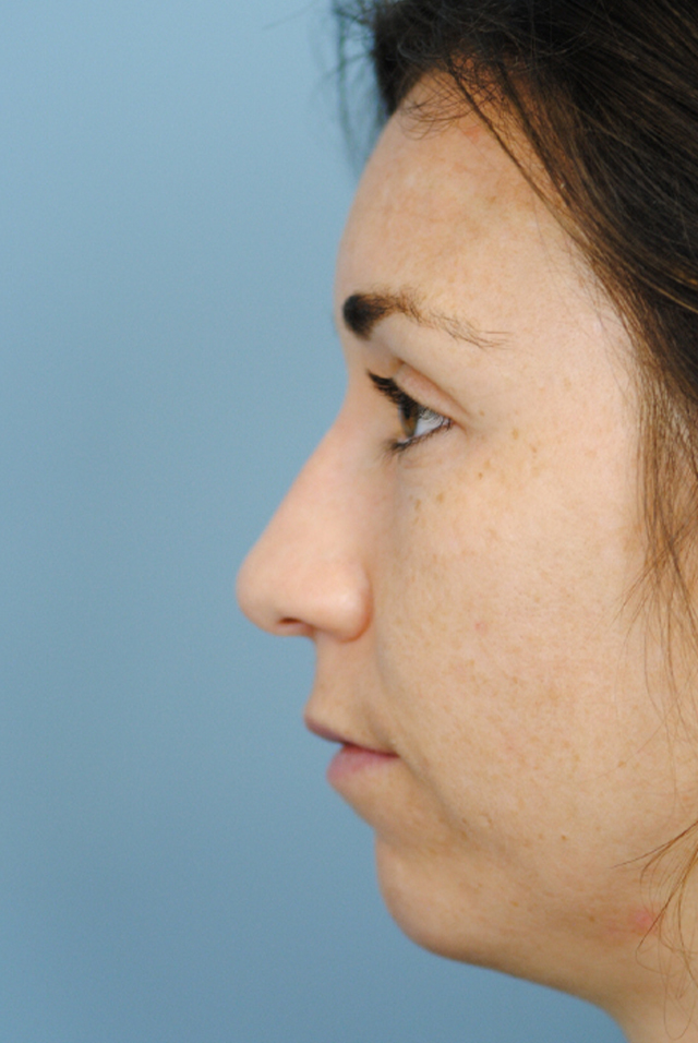 Rhinoplasty Before and After | Thomas Funcik MD