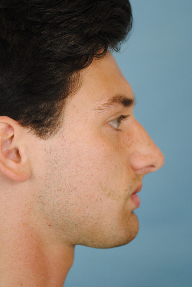 Rhinoplasty Before and After | Thomas Funcik MD