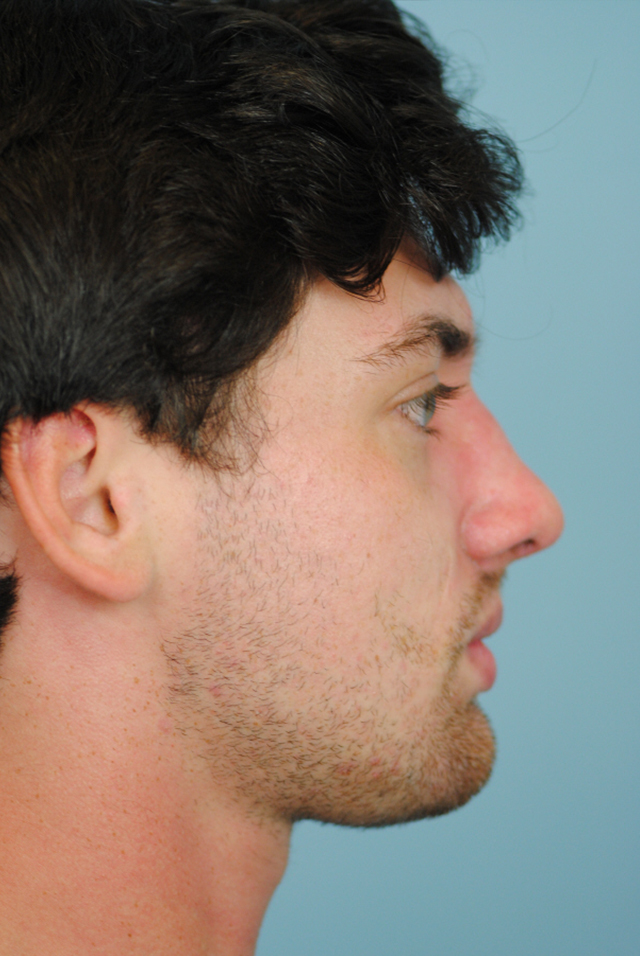 Rhinoplasty Before and After | Thomas Funcik MD