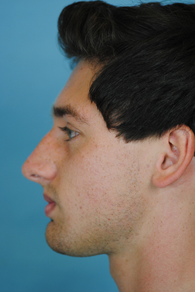 Rhinoplasty Before and After | Thomas Funcik MD