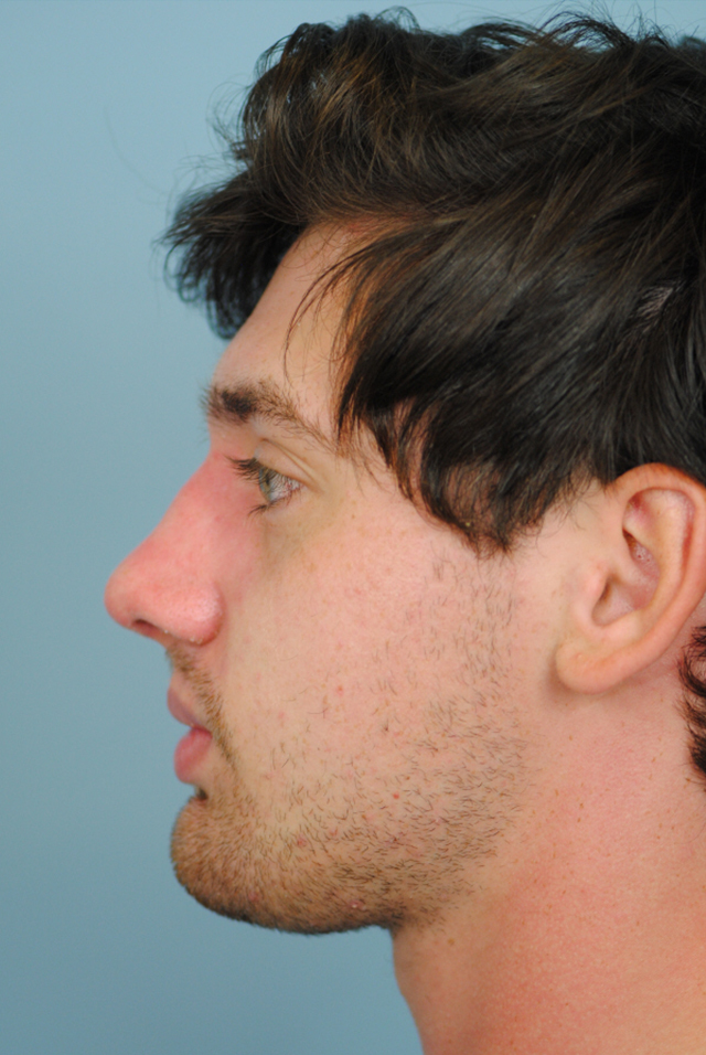 Rhinoplasty Before and After | Thomas Funcik MD