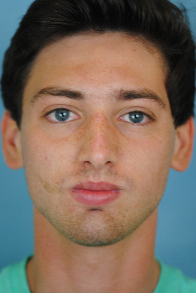 Rhinoplasty Before and After | Thomas Funcik MD