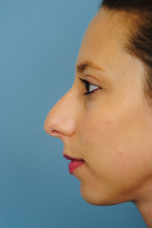 Rhinoplasty Before and After | Thomas Funcik MD