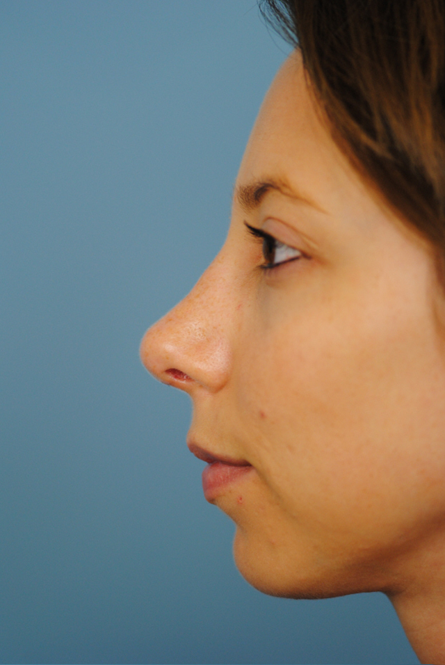 Rhinoplasty Before and After | Thomas Funcik MD