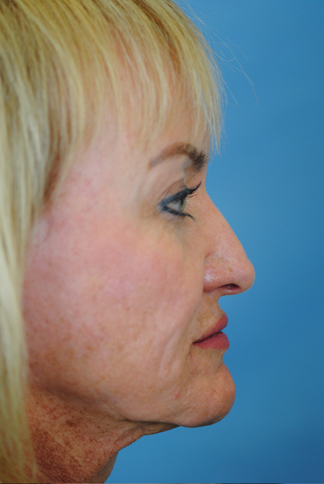 Rhinoplasty Before and After | Thomas Funcik MD