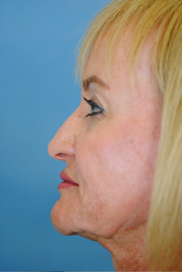 Rhinoplasty Before and After | Thomas Funcik MD