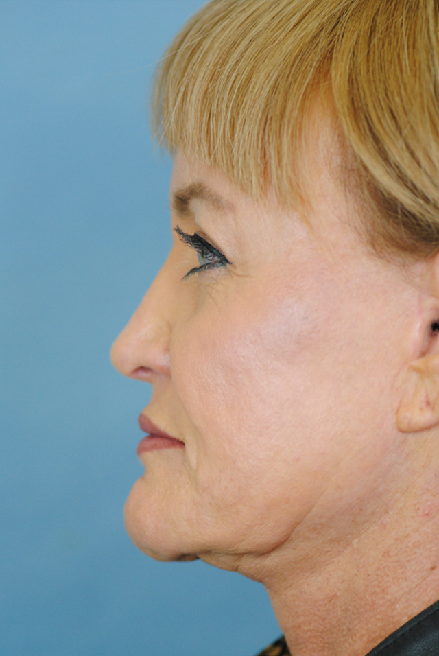 Rhinoplasty Before and After | Thomas Funcik MD