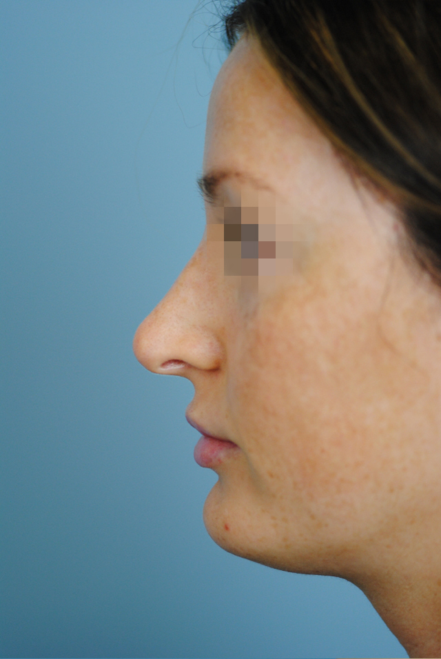 Rhinoplasty Before and After | Thomas Funcik MD