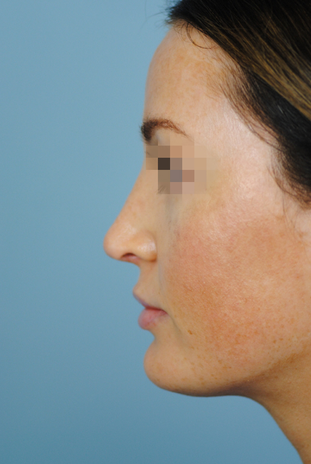 Rhinoplasty Before and After | Thomas Funcik MD