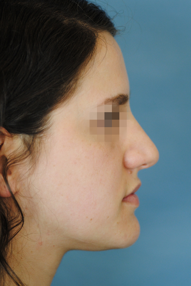 Rhinoplasty Before and After | Thomas Funcik MD