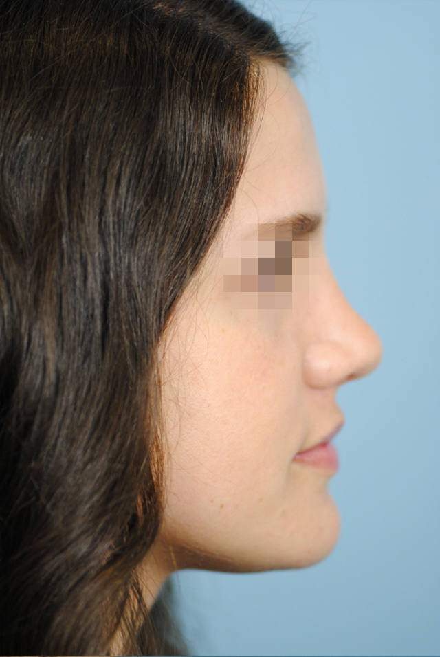 Rhinoplasty Before and After | Thomas Funcik MD