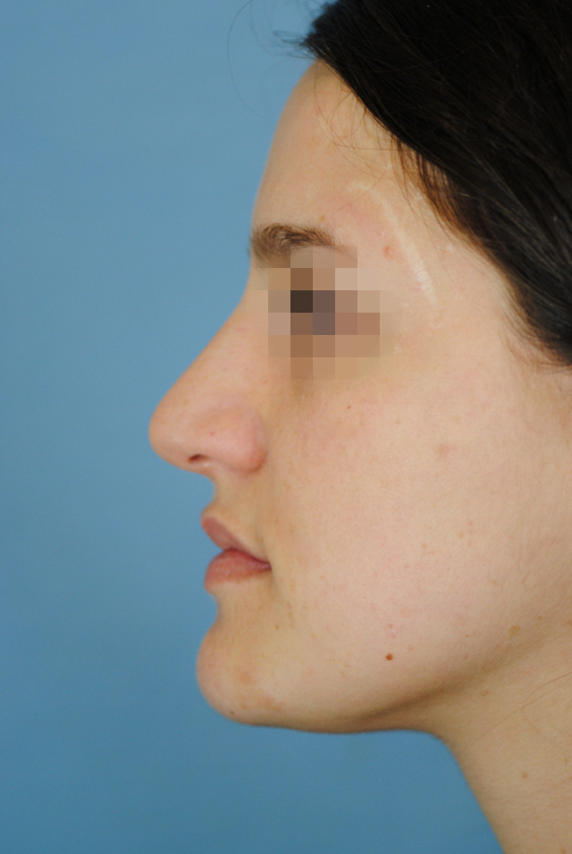 Rhinoplasty Before and After | Thomas Funcik MD