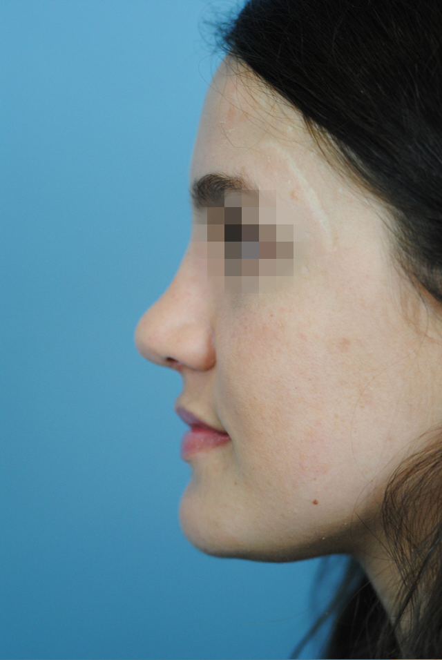 Rhinoplasty Before and After | Thomas Funcik MD