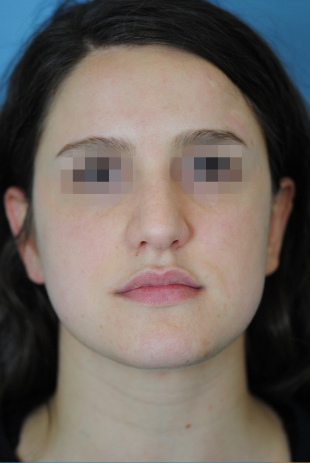 Rhinoplasty Before and After | Thomas Funcik MD