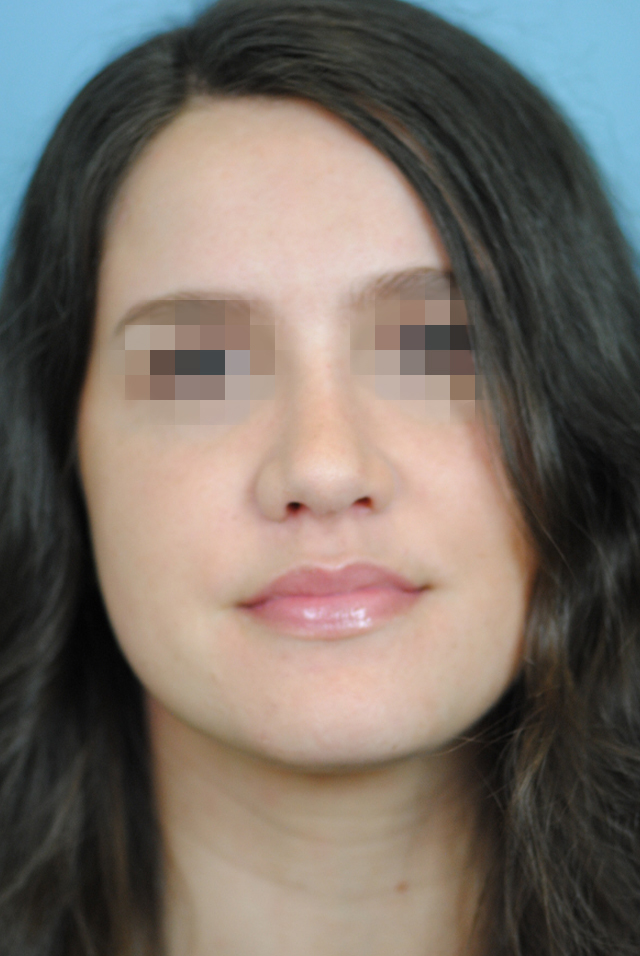 Rhinoplasty Before and After | Thomas Funcik MD