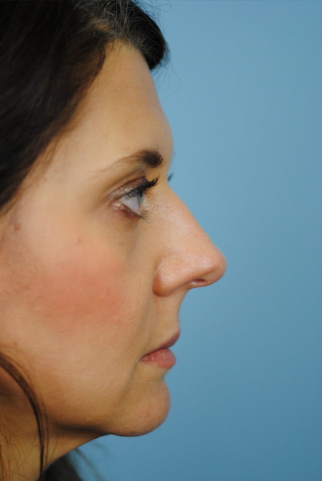 Rhinoplasty Before and After | Thomas Funcik MD