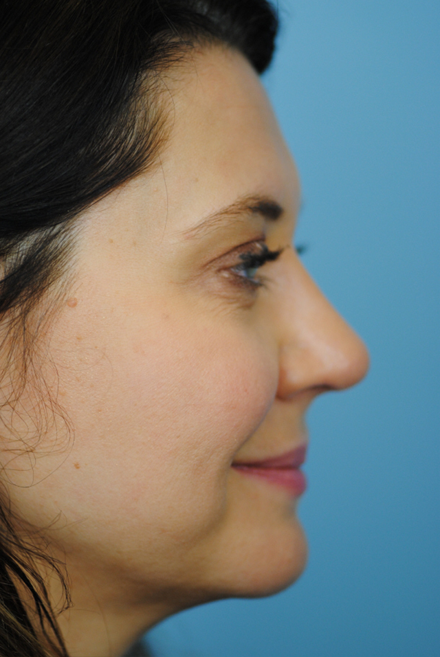 Rhinoplasty Before and After | Thomas Funcik MD