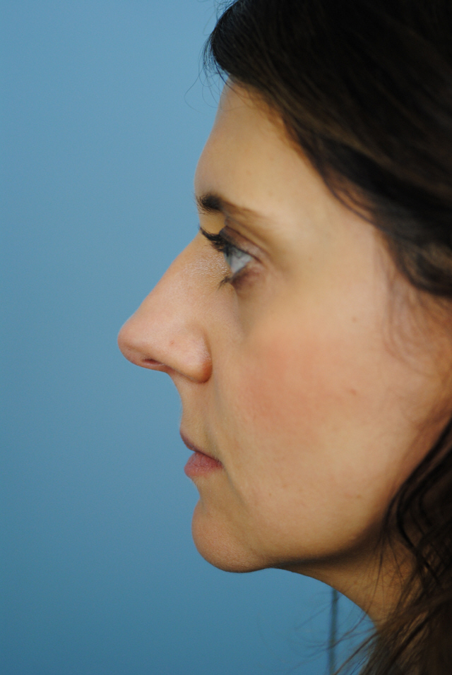 Rhinoplasty Before and After | Thomas Funcik MD