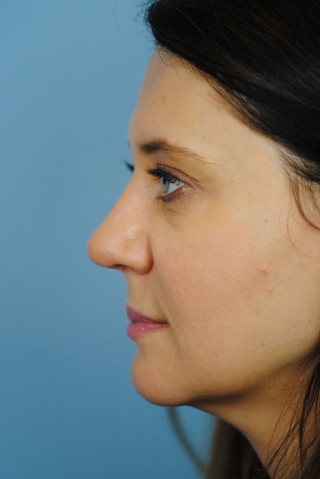 Rhinoplasty Before and After | Thomas Funcik MD