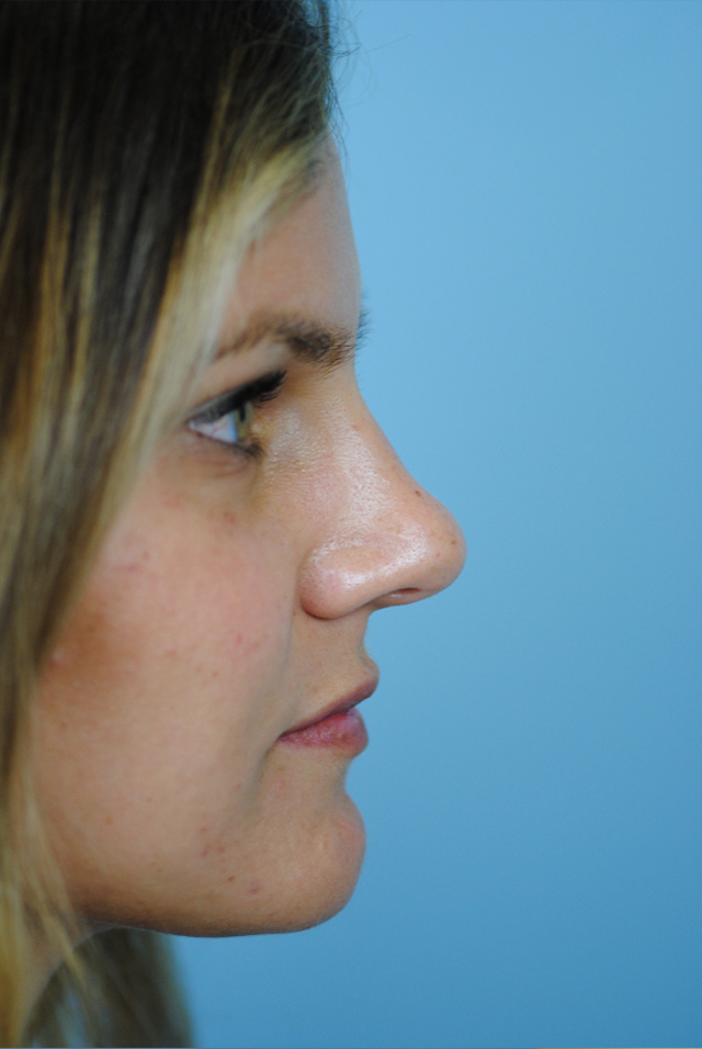 Rhinoplasty Before and After | Thomas Funcik MD