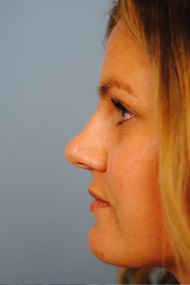 Rhinoplasty Before and After | Thomas Funcik MD