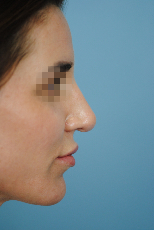 Rhinoplasty Before and After | Thomas Funcik MD