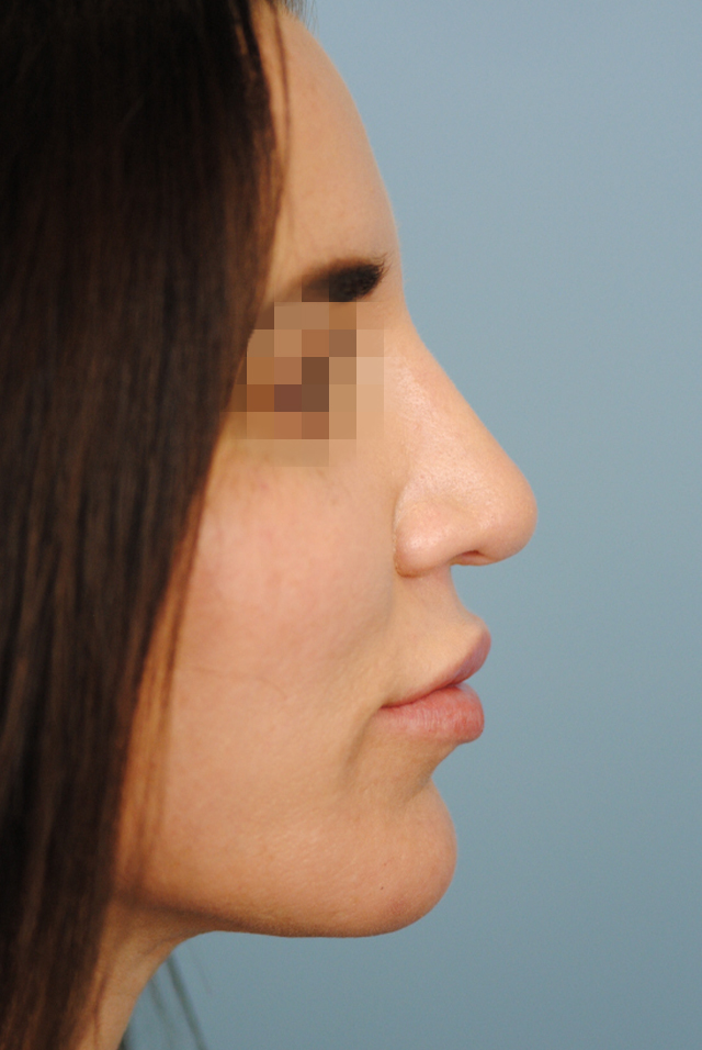 Rhinoplasty Before and After | Thomas Funcik MD