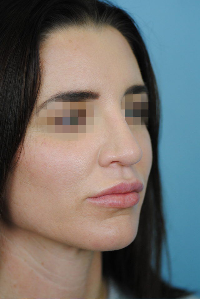 Rhinoplasty Before and After | Thomas Funcik MD