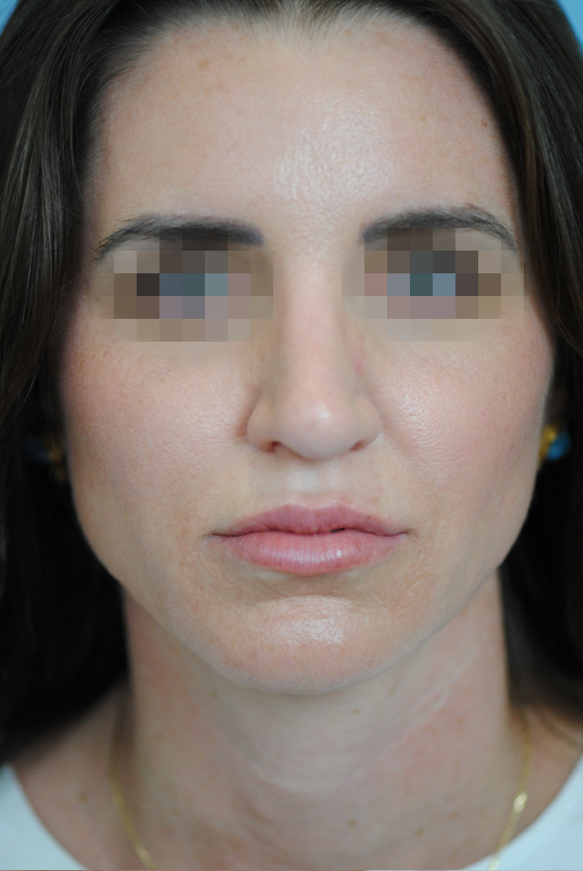 Rhinoplasty Before and After | Thomas Funcik MD