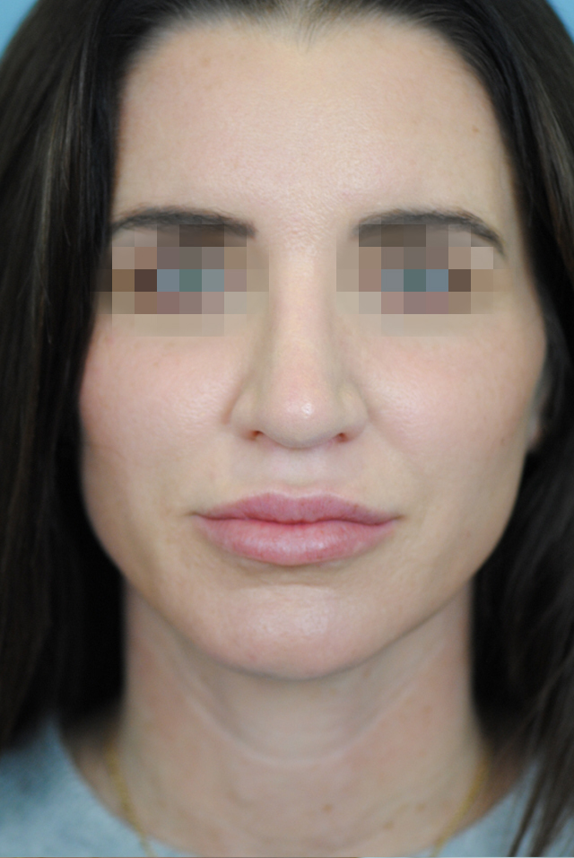 Rhinoplasty Before and After | Thomas Funcik MD