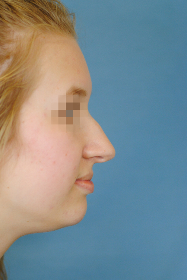 Rhinoplasty Before and After | Thomas Funcik MD